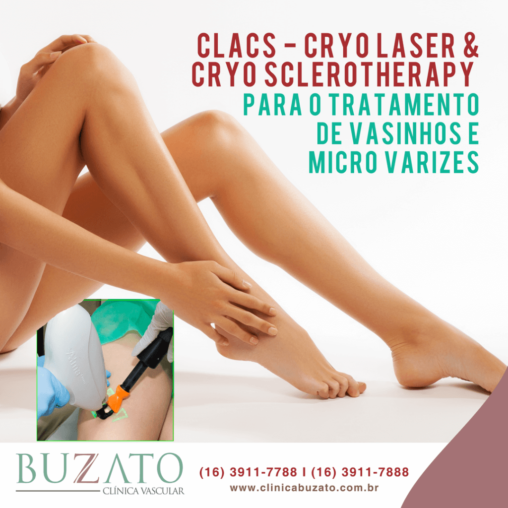 Para o tratamento de vasinhos e micro varizes